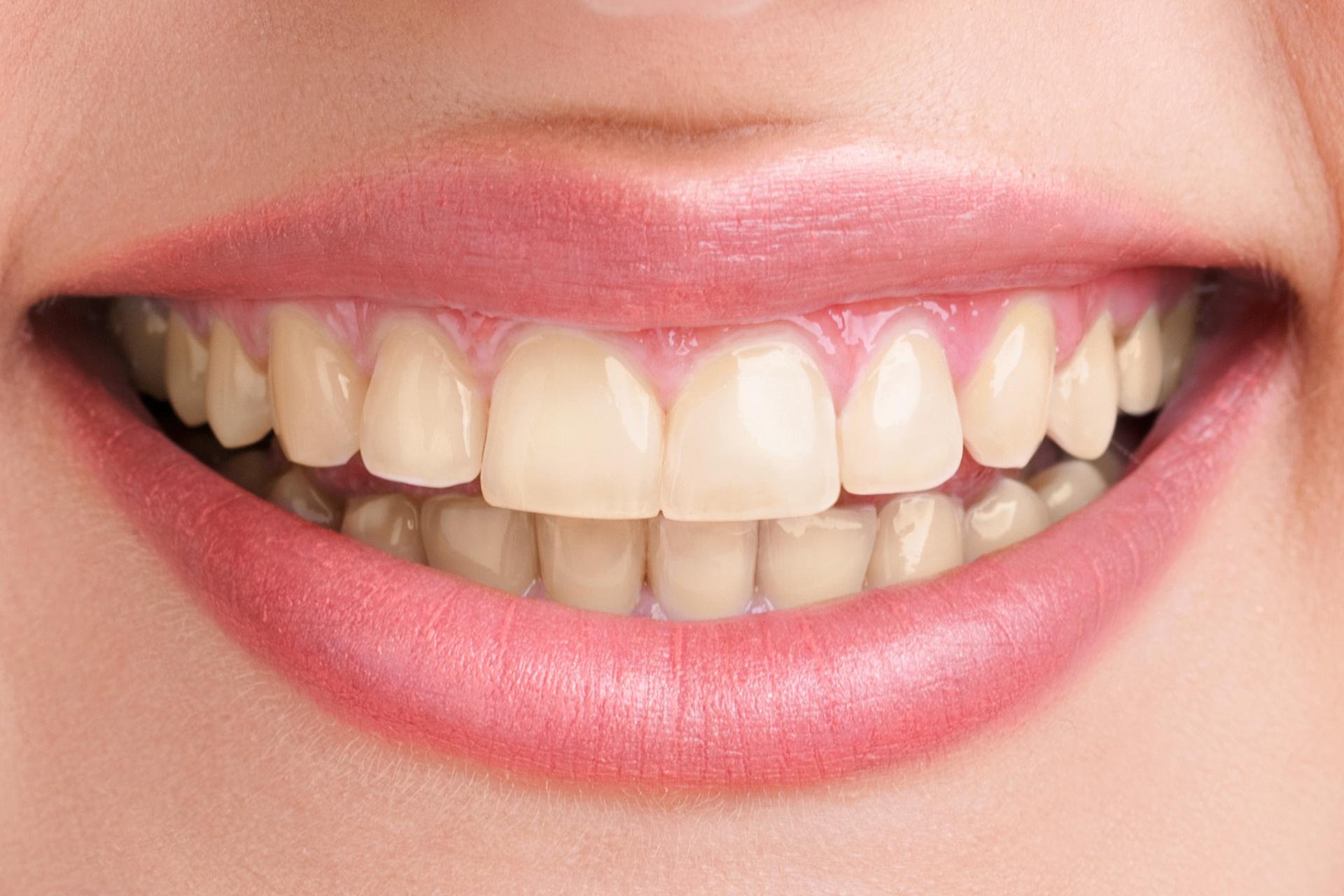 teeth-whitening-before-1